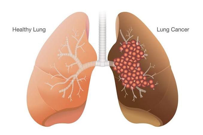 Yuk kenali Apa Itu Kanker Paru-paru?