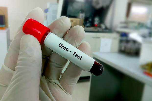 Proteinuria Indikasi Penyakit Gagal Ginjal